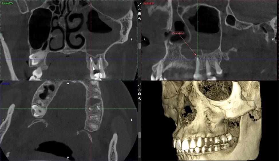 Estudio de senos nasales G7 de baja radiación CBCT Planmeca